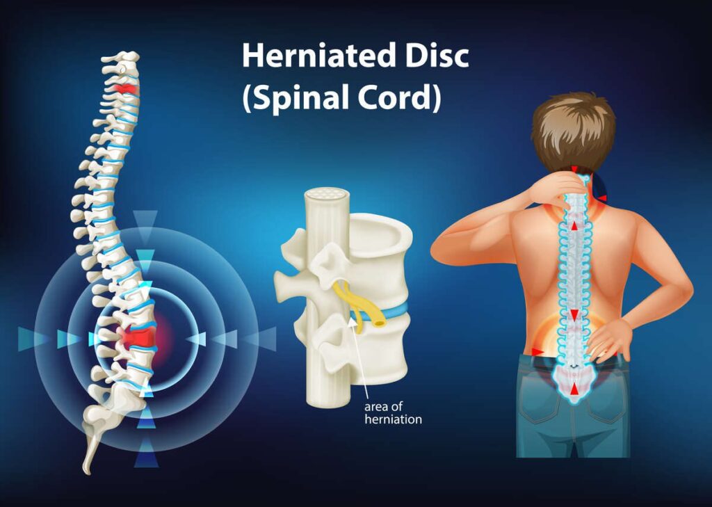 herniated disc symptoms