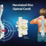 herniated disc symptoms