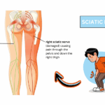 sciatica symptoms