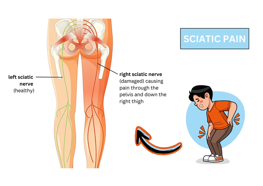 sciatica symptoms